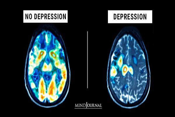 افسردگی چگونه به مغز آسیب می‌زند